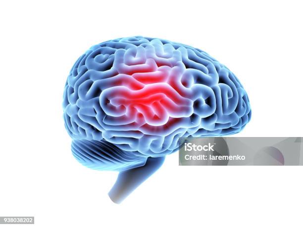 Mri Brain With Headache Stock Photo - Download Image Now - Shock, Concussion, Brain