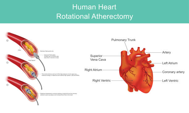 illustrazioni stock, clip art, cartoni animati e icone di tendenza di angioplastica a diamante cardiaco - pain heart attack heart shape healthcare and medicine