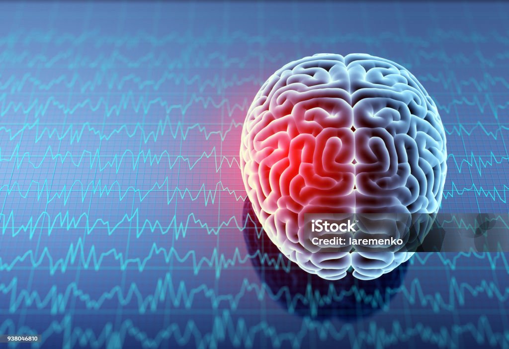 Mri brain with headache. Headache area on brain X-ray, 3D illustration. Shock Stock Photo