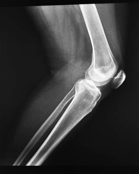 istock X ray image - woman knee 938439874