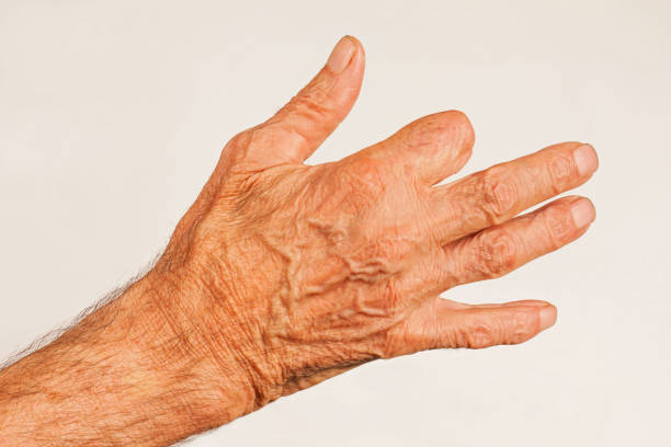 istock Elderly man hand with amputated finger 938625890