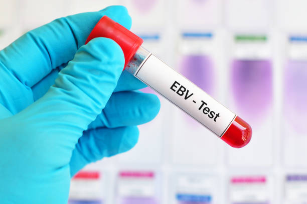 Epstein-Barr virus (EBV) test Test tube with blood sample for Epstein-Barr virus (EBV) test epstein barr virus photos stock pictures, royalty-free photos & images