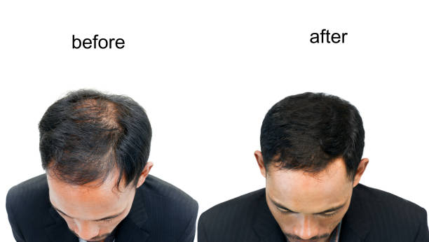 before and after bald head before and after bald head of a man on white background. hair loss stock pictures, royalty-free photos & images