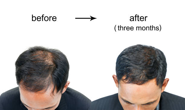 before and after bald head. before and after bald head of a man on white background. balding photos stock pictures, royalty-free photos & images
