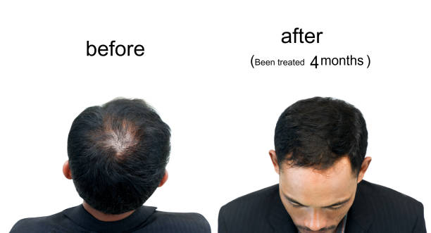 istock bald head of a man 938994686