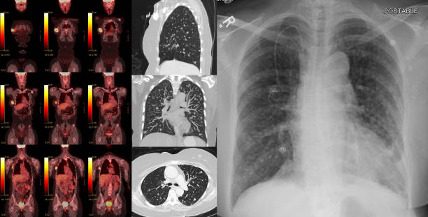 tumore al seno con metastasi polmonari in una giovane donna - pet foto e immagini stock