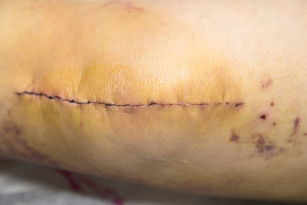 patient month after surgery, long scar on knee control of healing, clear the skin. hospital health care. knee prosthesis postoperative - chest drain imagens e fotografias de stock
