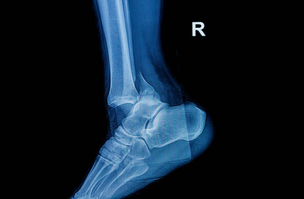 istock Fracture ankle fibula bone ( leg bone ) X-ray of leg side and view 940334552