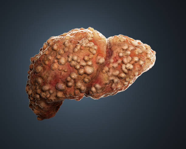 3d rendered cirrotic liver. 3d rendered illustration of a cirrotic liver. liver failure stock pictures, royalty-free photos & images