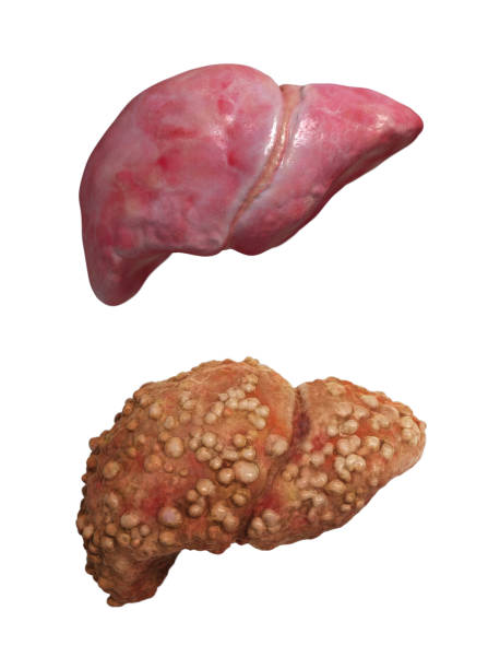 Normal liver and liver cancer. stock photo