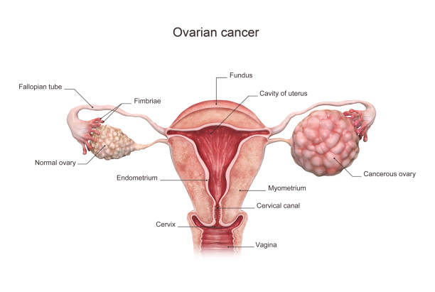 3d rendered ovarian cancer illustration. stock photo