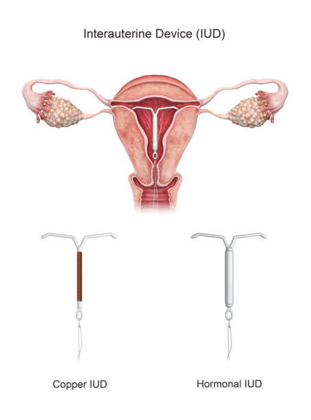dispositivo intrauterino renderizado 3d. - vagina contraceptive gynecologist doctor fotografías e imágenes de stock