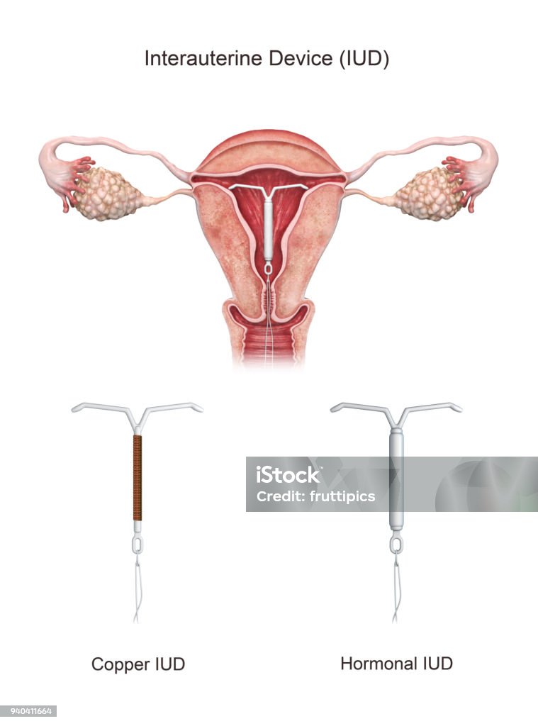 3d rendered intra-uterine device. 3d rendered illustration of an intra-uterine device. IUD Stock Photo