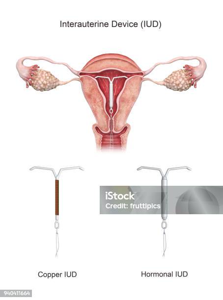 3d Rendered Intrauterine Device Stock Photo - Download Image Now - IUD, Copper, Contraceptive