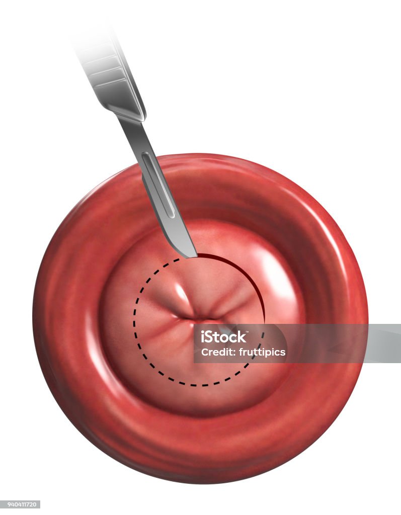 Cone Biopsy Illustration Stock Photo Download Image Now Anatomy cone-biopsy-illustration-stock-photo-download-image-now-anatomy