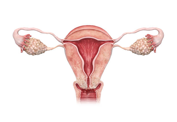 Illustration of a cervical cancer. stock photo