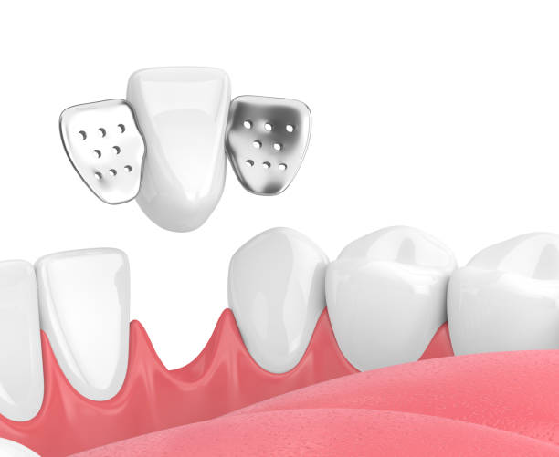 istock 3d render of jaw with teeth and maryland bridge 940902096