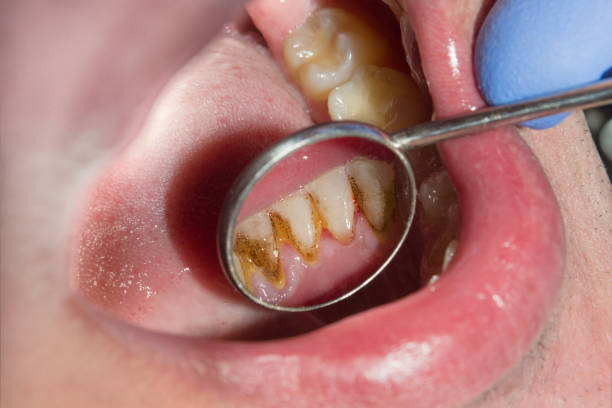 primer plano de macro cálculo dental y placa dental. higiene bucal en odontología - colmillo fotografías e imágenes de stock