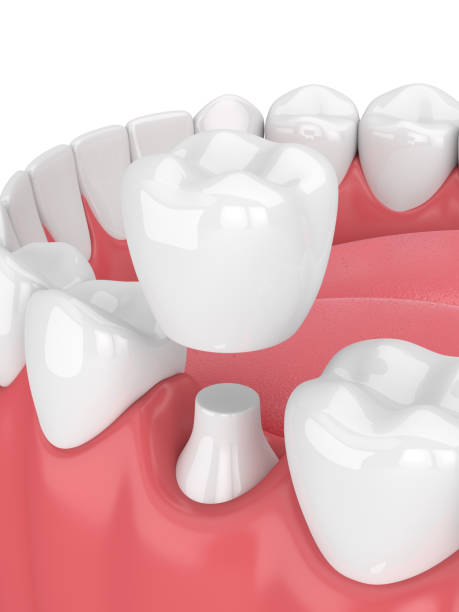 istock 3d render of jaw with teeth and dental crown restoration 940969392