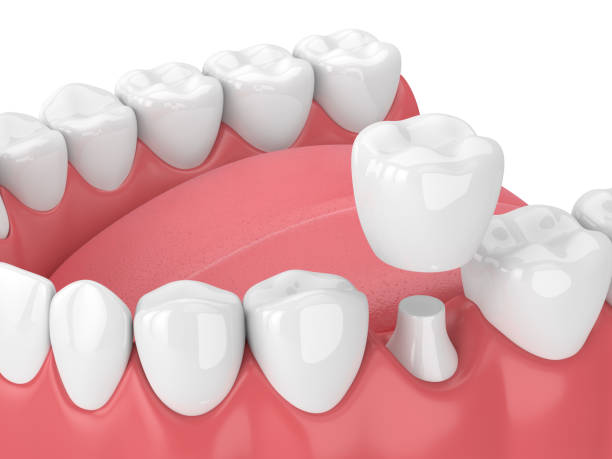 3d render de la mandíbula con los dientes y la restauración de la corona dental - corona-dental fotografías e imágenes de stock