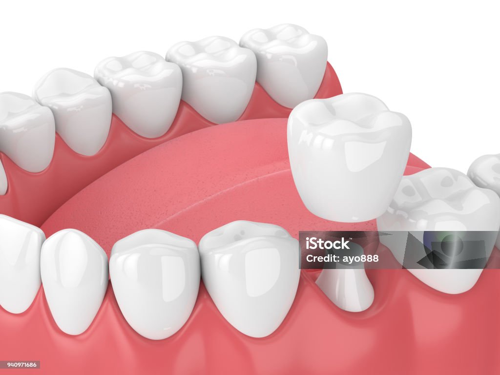 3d render of jaw with teeth and dental crown restoration 3d render of jaw with teeth and dental crown restoration over white background Tooth Crown Stock Photo