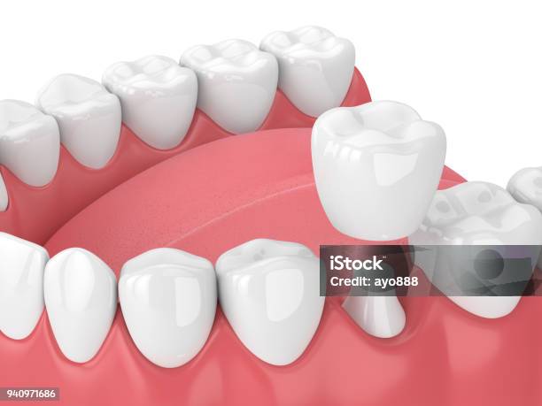 3d Render Of Jaw With Teeth And Dental Crown Restoration Stock Photo - Download Image Now