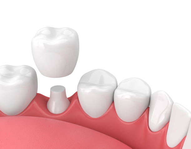 istock 3d render of jaw with teeth and dental crown restoration 940975604