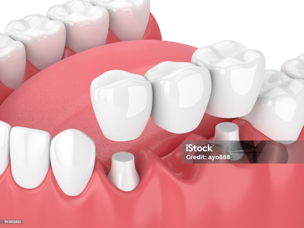 3d render of jaw with dental bridge 3d render of jaw with dental bridge  over white background Dental Bridge Stock Photo