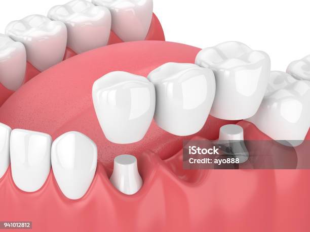 3d Render Of Jaw With Dental Bridge Stock Photo - Download Image Now - Dental Bridge, Tooth Crown, Implant