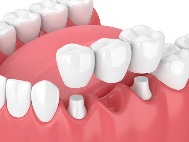 3d render szczęki z mostkiem dentystycznym - bridge zdjęcia i obrazy z banku zdjęć