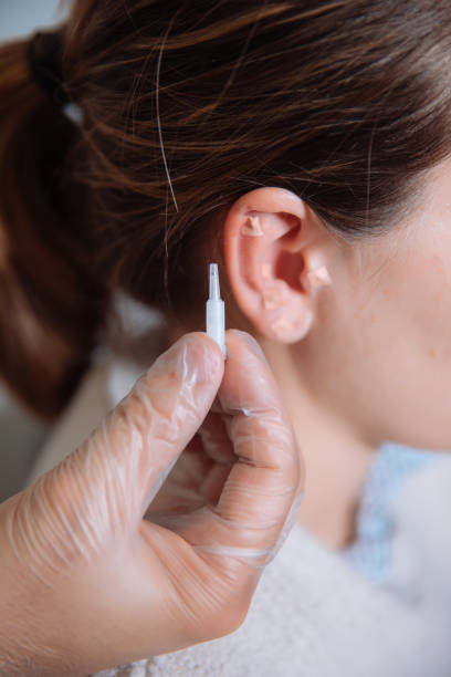 istock doctor putting acupuncture needles in the ear 941017916