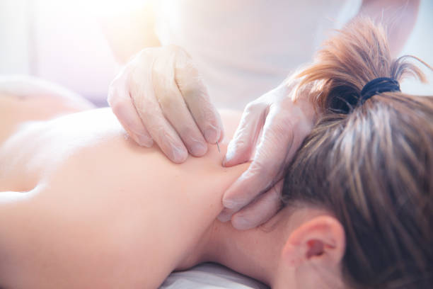 Physiotherapist doing acupuncture to a young woman on her back Physiotherapist doing acupuncture to a young woman on her back acupuncture photos stock pictures, royalty-free photos & images