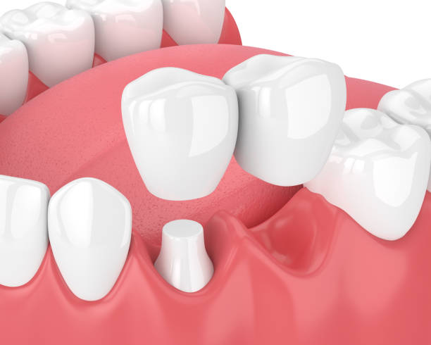 istock 3d render of jaw with dental cantilever bridge 941021332