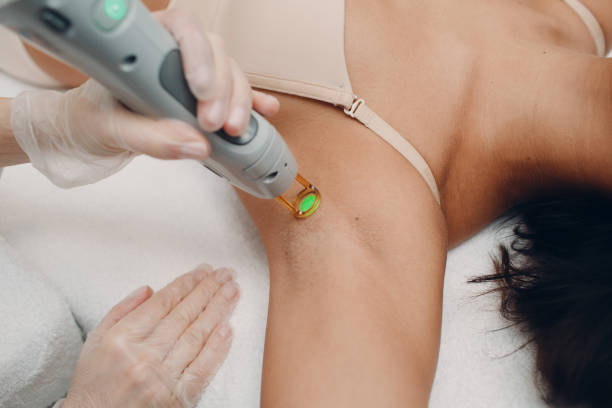 Laser epilation of armpits and cosmetology. Hair removal cosmetology procedure. Laser epilation and cosmetology. Cosmetology and SPA concept. stock photo