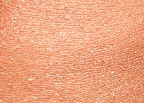 the texture of the epidermis of human skin with flakes and cracked particles closeup