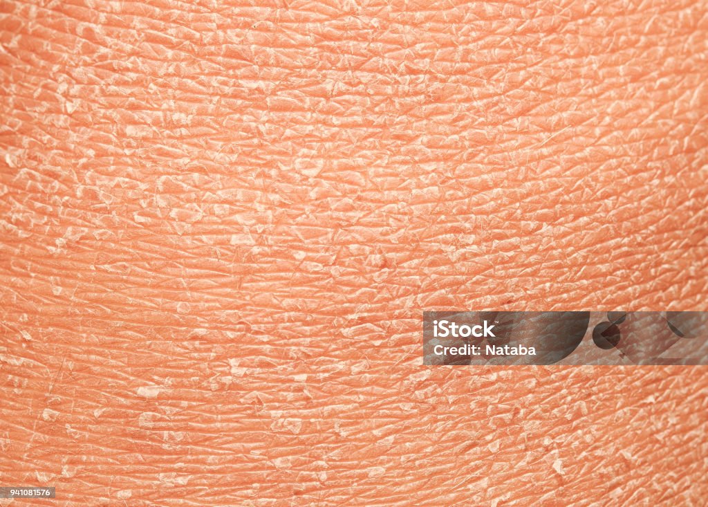 unhealthy human skin epidermis texture with flaking and cracked particles close-up the texture of the epidermis of human skin with flakes and cracked particles closeup Skin Stock Photo