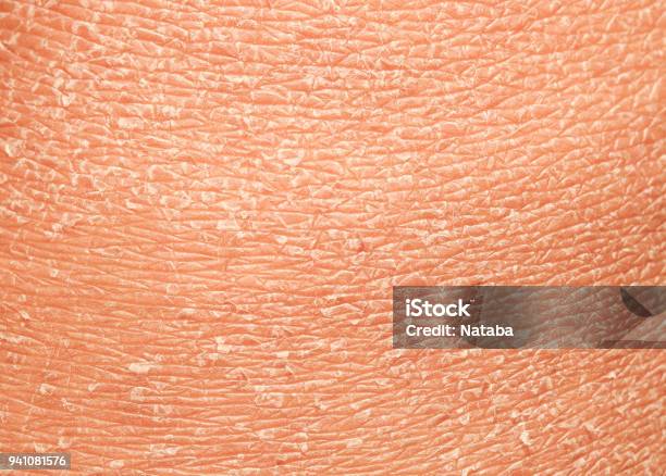 Unhealthy Human Skin Epidermis Texture With Flaking And Cracked Particles Closeup Stock Photo - Download Image Now