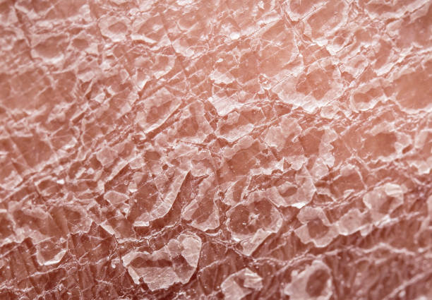 нездоровая текстура эпидермиса кожи человека с шелушение и трещины частиц крупным планом - dry skin close up horizontal macro стоковые фото и изображения
