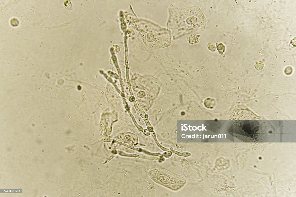 Sel Ragi Urin Pseudohyphae Dan Tunas Sel Ragi Dalam Urin Foto Stok - Unduh Gambar ...