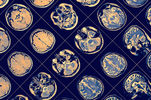인간 두뇌의 미스터 이미지입니다. - alzheimers disease 뉴스 사진 이미지