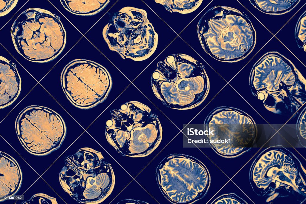 MR image of human brain. MR image of human brain Parkinson's Disease Stock Photo