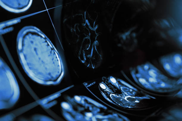 istock Magnetic resonance imaging of human brain with suspected cerebropathy 941361114