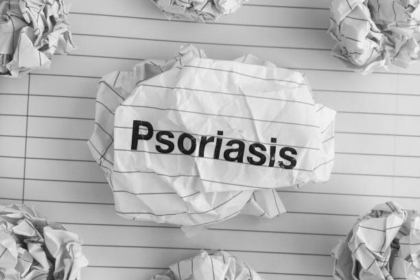 istock Psoriasis. Word Psoriasis on Crumpled Paper Ball 941366058