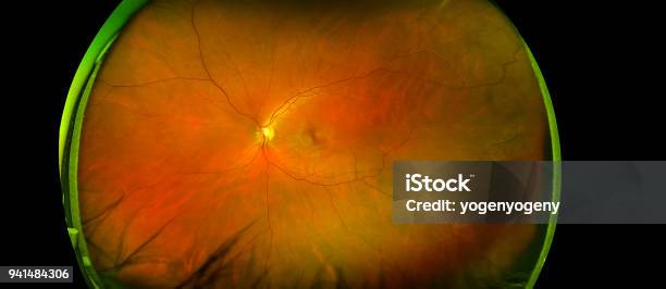 Eyes Retinal Angle Image With Macula Vessels And Optic Disc Isolated View On A Black Bacground Made By Ultra Wide Fundus Camera Stock Photo - Download Image Now