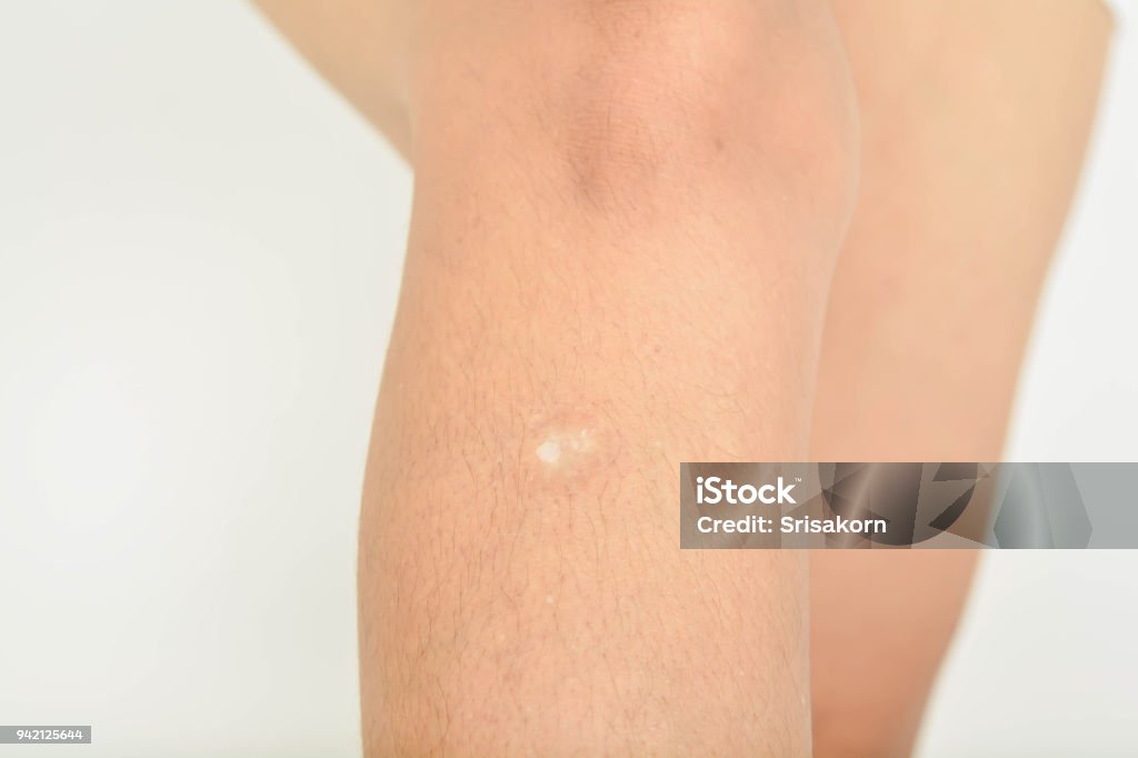 Ugly Scars On The Womans Legs Stock Photo - Download Image Now