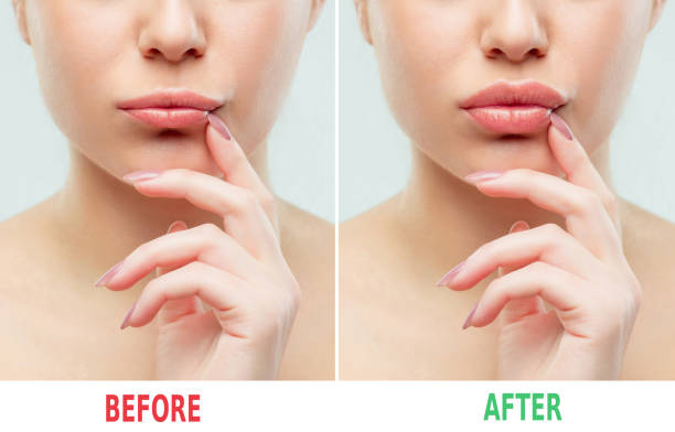 vor und nach den lippen füllstoff injektionen. schönheit aus kunststoff. schöne perfekte lippen mit natürliches make-up - big lips stock-fotos und bilder