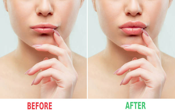 avant et après les injections de remplissage des lèvres. plastique de la beauté. belles lèvres parfaites avec le maquillage naturel - sexy lips photos et images de collection