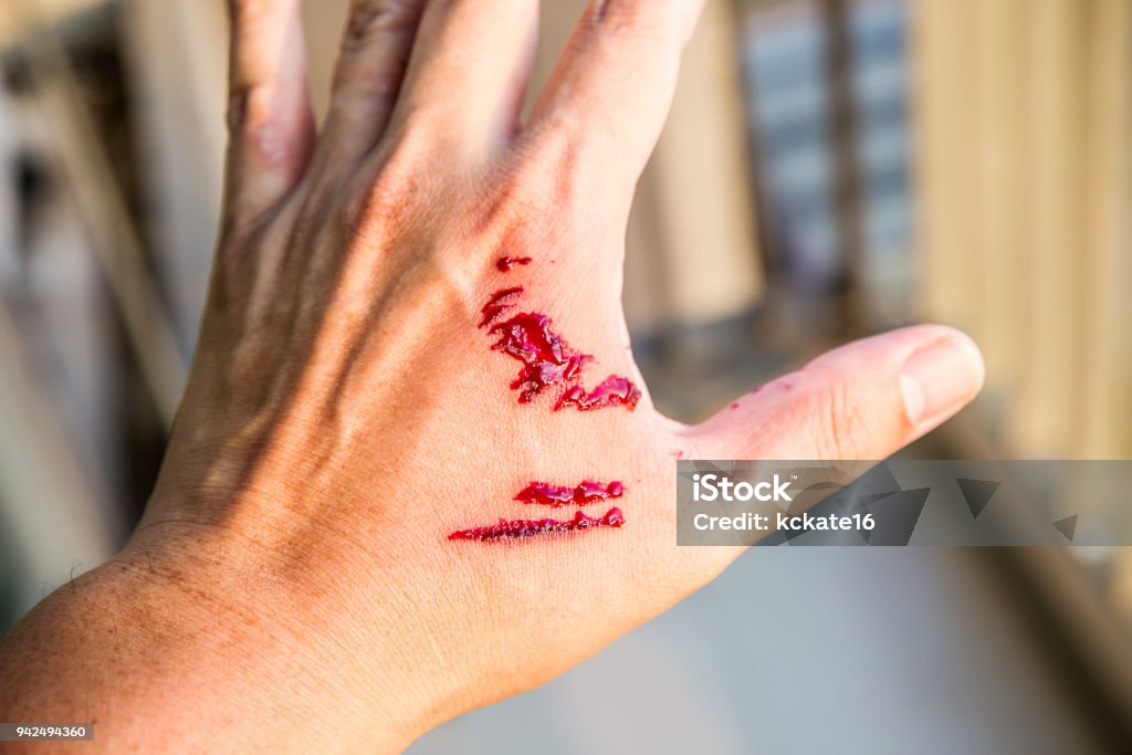 Focus dog bite wound and blood on hand. Infection and Rabies concept. Focus dog bite wound and blood on hand. Infection and Rabies concept. Pet care and rabies prevention concept. Accidental and first aid concept. image for background, objects, copy space. Biting Stock Photo