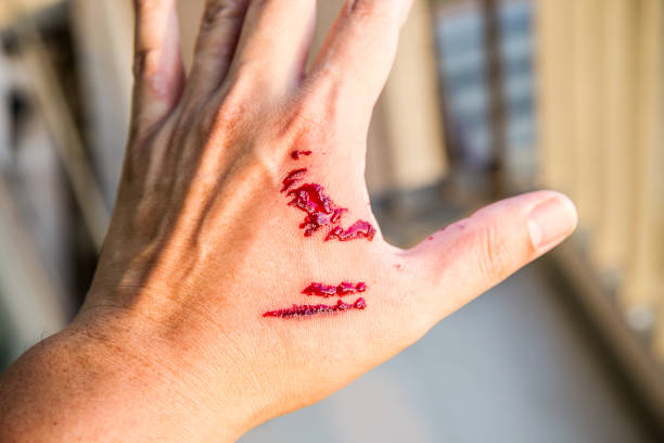 Focus dog bite wound and blood on hand. Infection and Rabies concept. stock photo