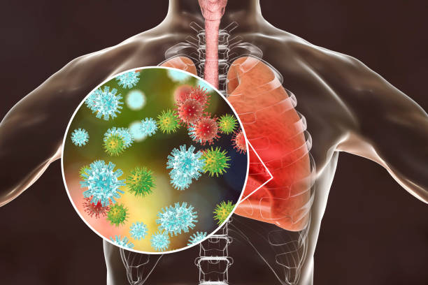 virus di paru-paru manusia - sindrom pernapasan akut berat potret stok, foto, & gambar bebas royalti